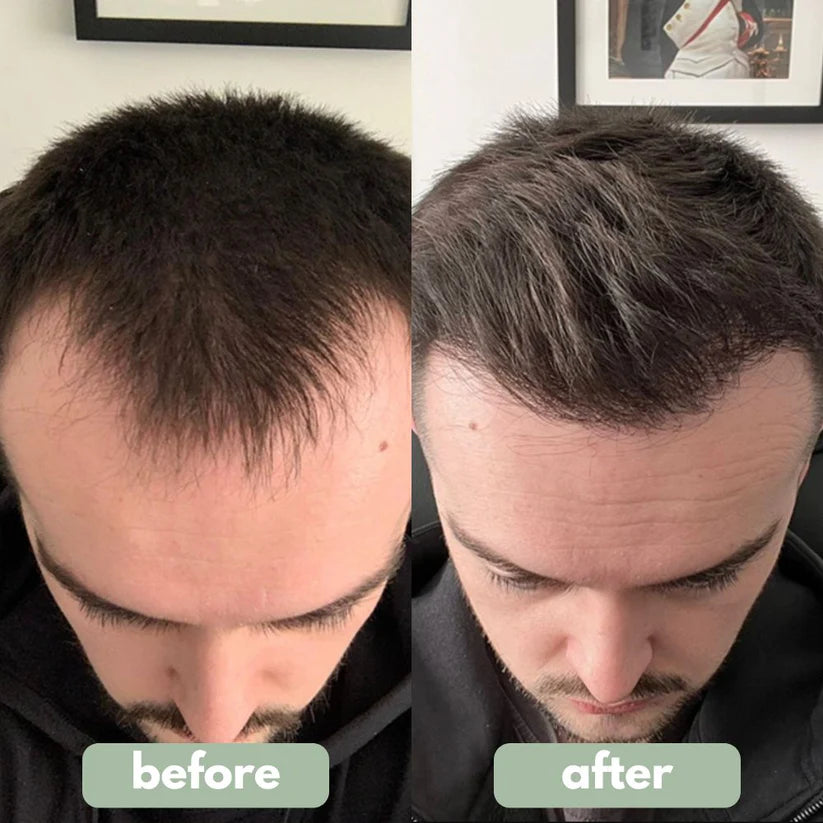 Rosemary Hair Serum Roll-On (Ultimate Combo)